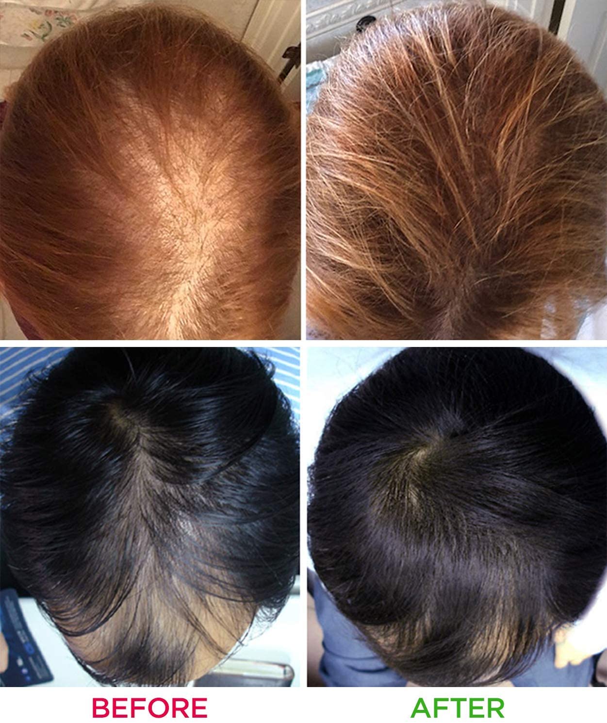 iRestore Laser Hair Growth System