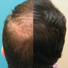CapillusPlus Mobile Laser Therapy Cap for Hair Regrowth