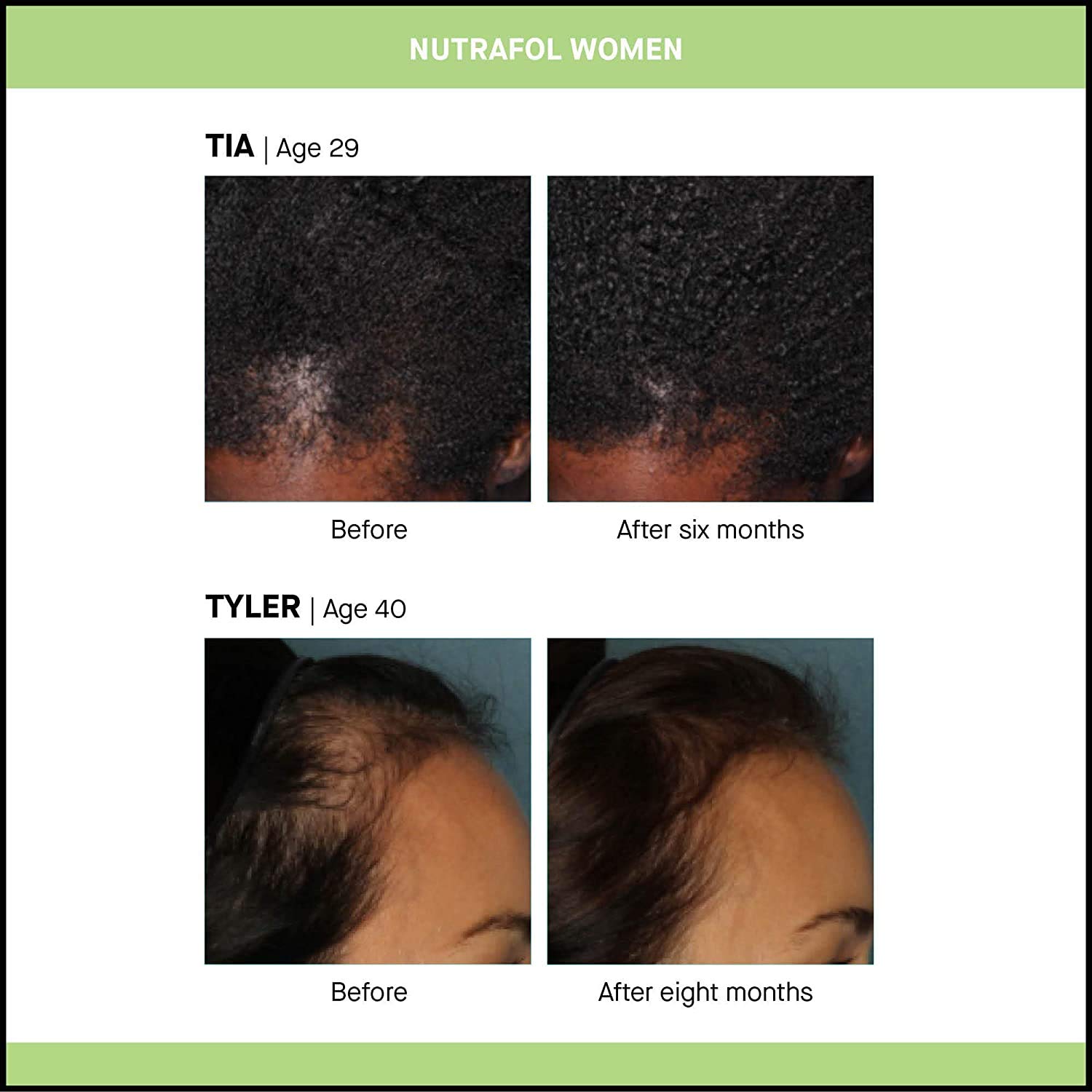 Nutrafol Women Hair Growth Supplement For Thicker  - 2 Bottles