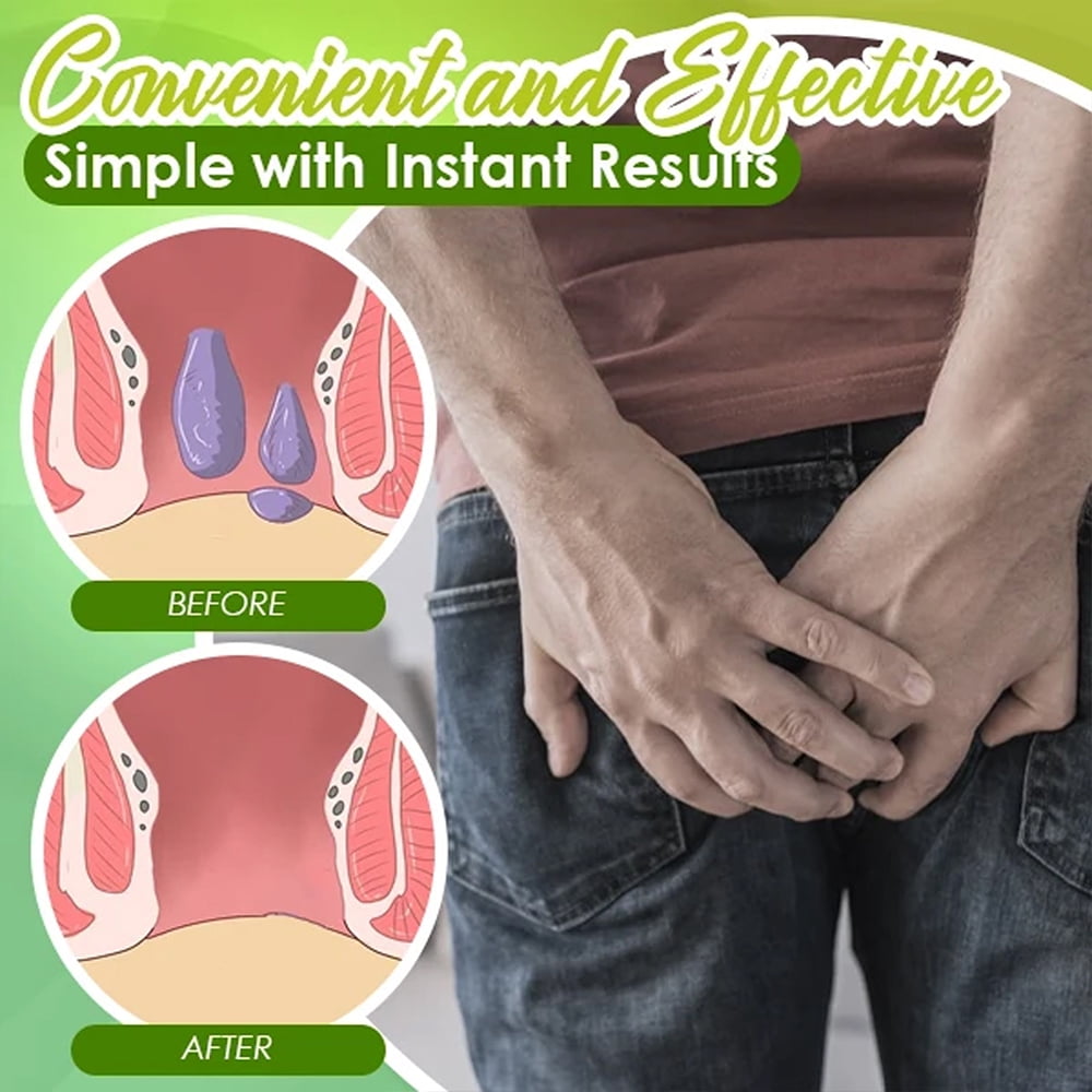 Herbal Hemorrhoids Spray Treatment Alleviates Pain