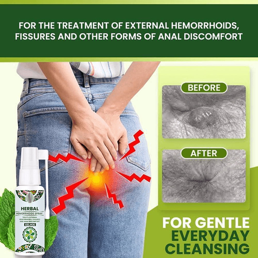 Herbal Hemorrhoids Spray Treatment Alleviates Pain