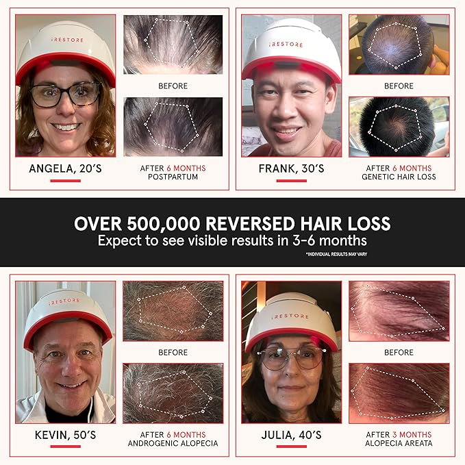 IRESTORE LASER HAIR GROWTH SYSTEM
