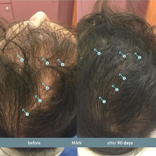 REVITA.SOD HAIR SUPPORT TABLETS ZINC, ASHWAGANDHA SOD FOR HAIR STRENGTH GROWTH