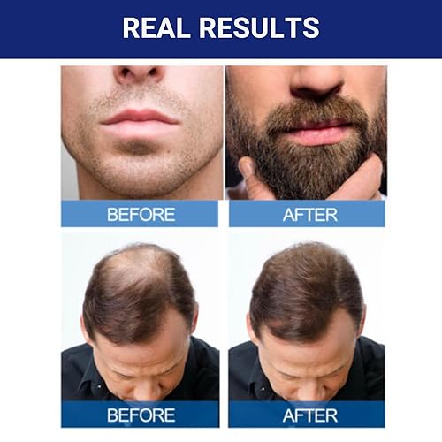 KIRKLAND SIGNATURE MINOXIDIL 5 FOR MEN HAIR REGROWTH - 1 MONTH SUPPLY, EFFECTIVE TREATMENT