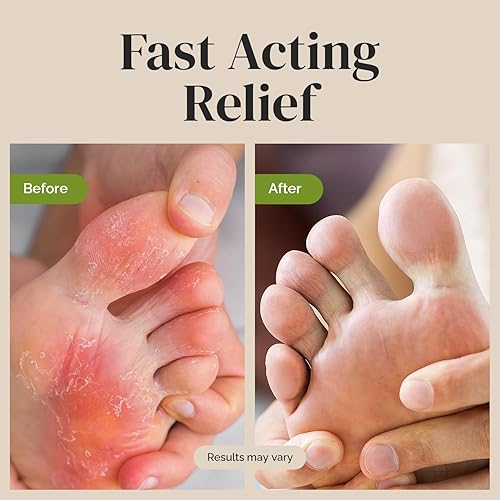 PURIYA EXTRA-STRENGTH ANTIFUNGAL CREAM FOR ATHLETES FOOT, JOCK ITCH RINGWORM, TEA TREE OIL