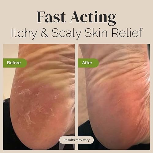 PURIYA EXTRA STRENGTH TEA TREE OIL BALM FOR JOCK ITCH, ATHLETES FOOT, RINGWORM, FAST RELIEF FOR ITCHY SKIN