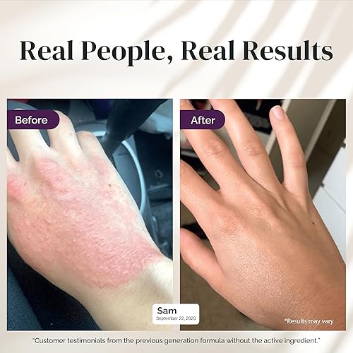 PURIYA 5-IN-1 ECZEMA CREAM FOR KIDS ADULTS, COLLOIDAL OATMEAL LOTION FOR DRY, ITCHY SKIN RELIEF