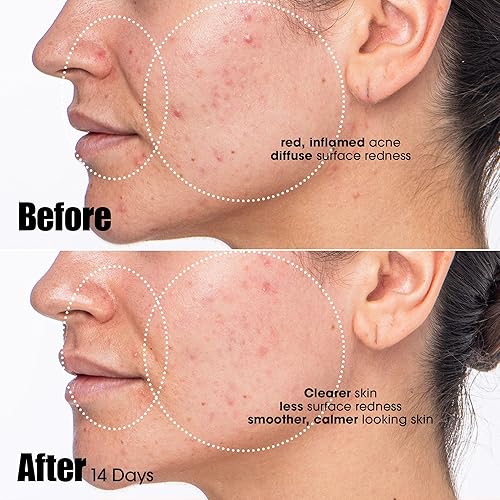 SUNDAY RILEY PEACEKEEPER AZELAIC SALICYLIC ACID ACNE TREATMENT SERUM FOR CLEAR SKIN BLEMISH PORE CONTROL