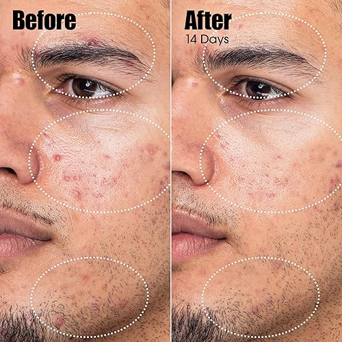 SUNDAY RILEY PEACEKEEPER AZELAIC SALICYLIC ACID ACNE TREATMENT SERUM FOR CLEAR SKIN BLEMISH PORE CONTROL