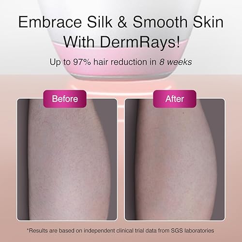 DERMRAYS 1064NM DIODE LASER HAIR REMOVAL FOR DARK MELANATED SKIN, PERMANENT REDUCTION