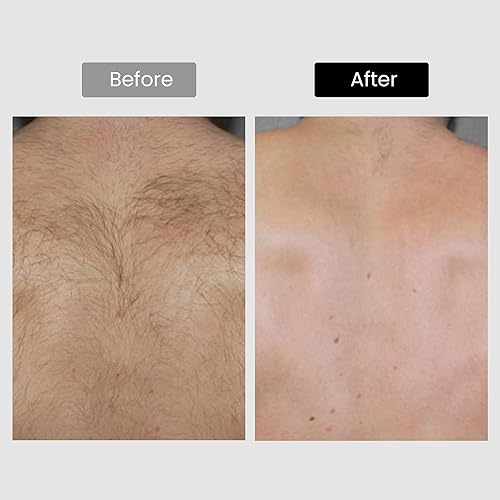 DERMRAY 810NM DIODE LASER HAIR REMOVAL DEVICE FOR SKIN TONE 1-5, PERMANENT HOME USE HAIR REDUCTION