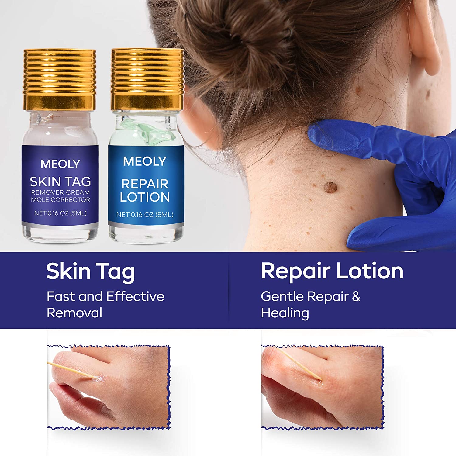 Meoly Mole Remover and Skin Tag Removal Repair Lotion Set-2