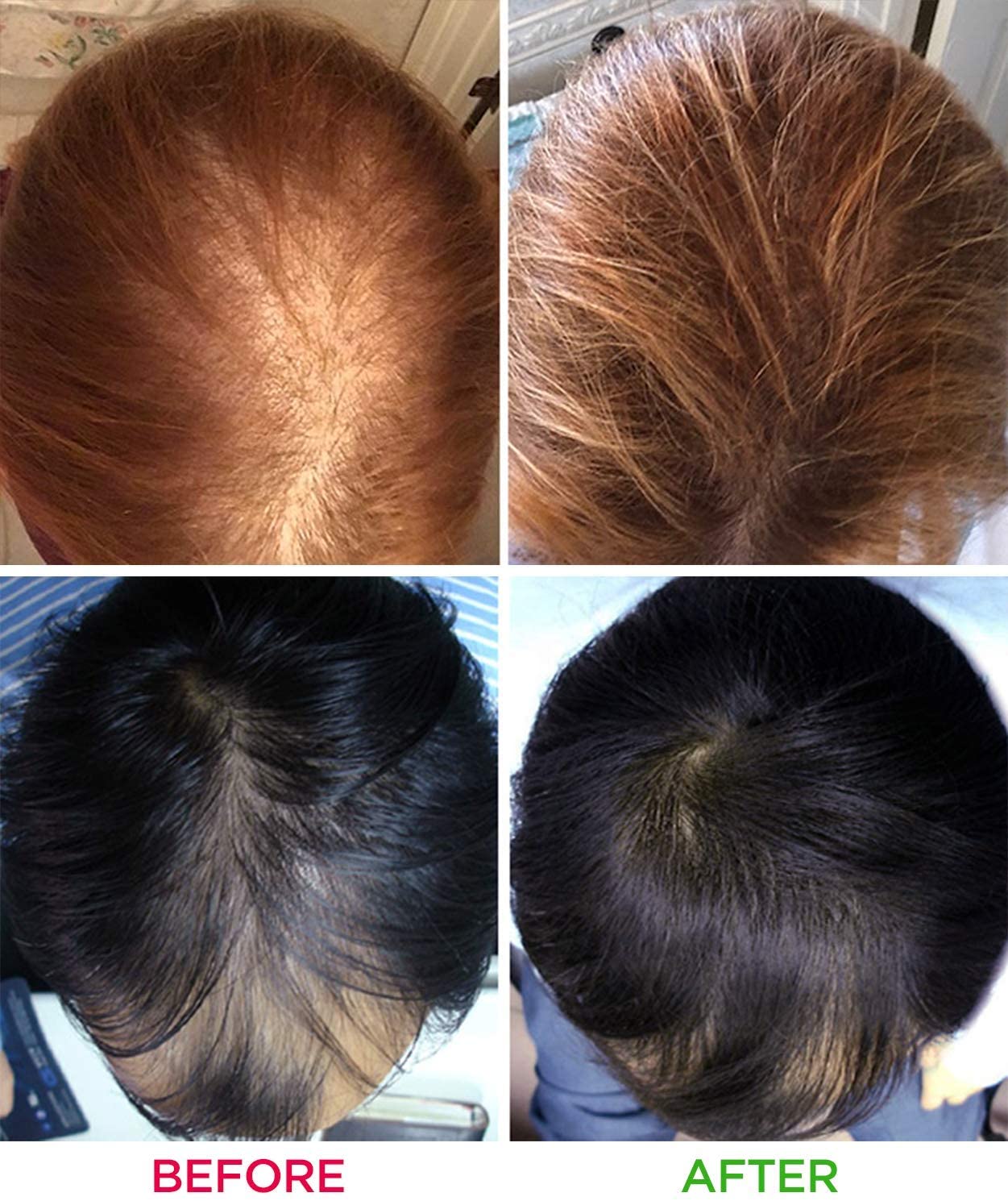 iRestore Laser Hair Growth System-1